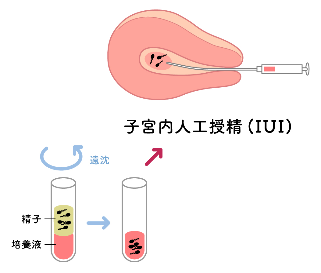 人工 授精 1 週間 後 胸 の 張り