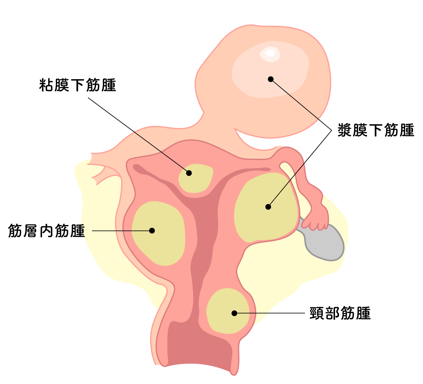 子宮筋腫の種類