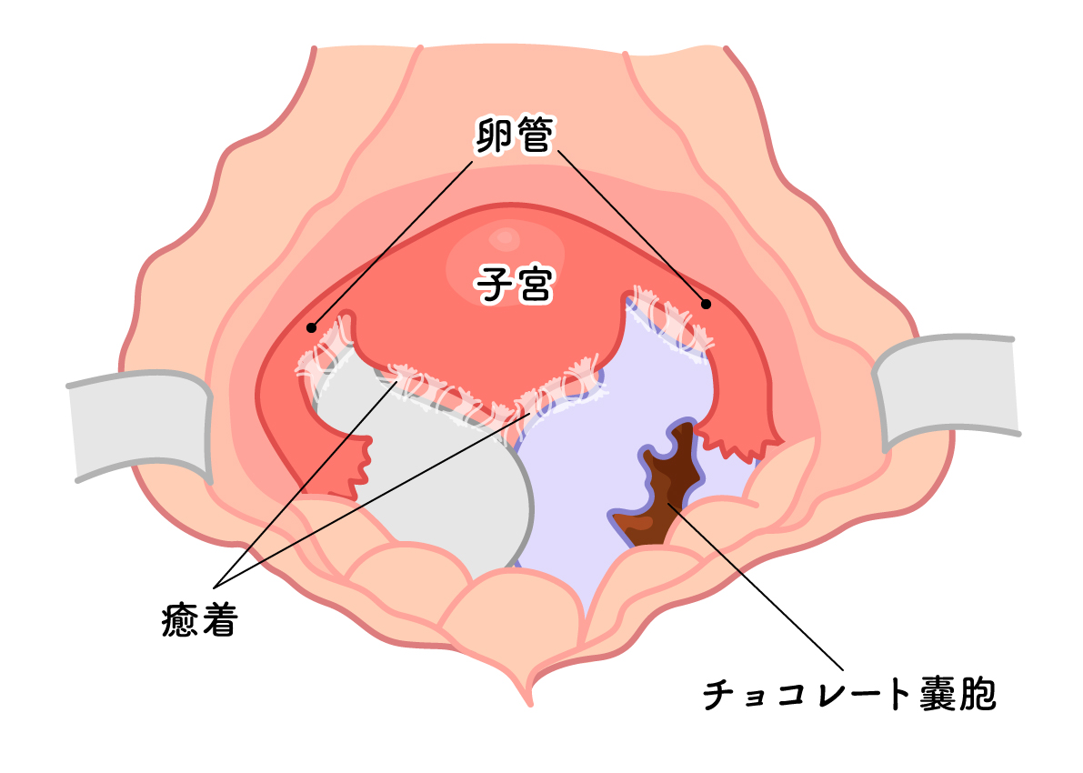 子宮内膜症