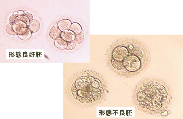 胚移植