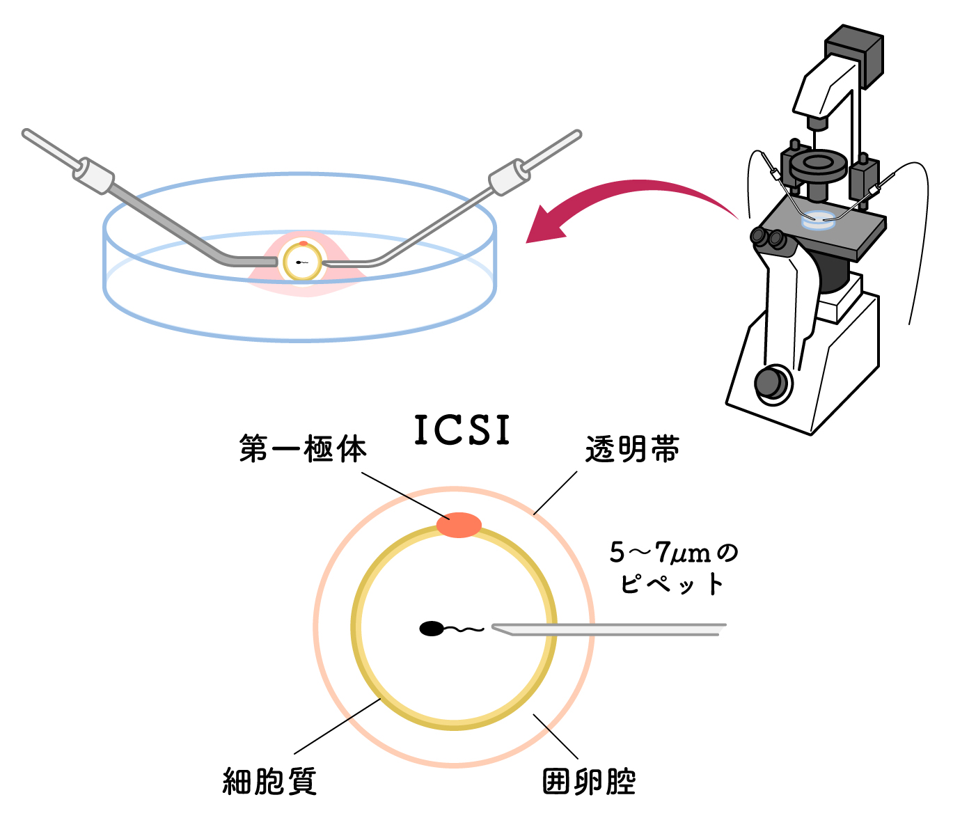 顕微授精（ICSI)